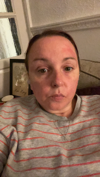 Please help identify this rash
