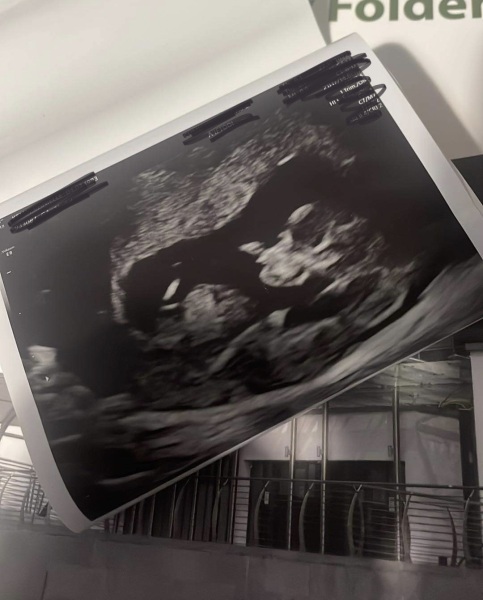 12 week ultra sound gender prediction