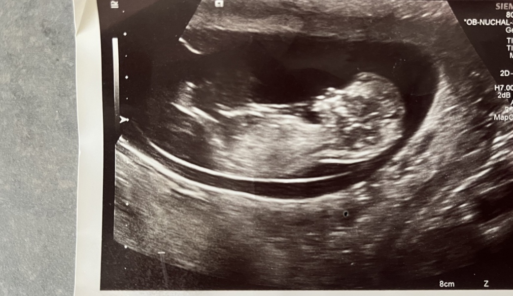 Interested to see if you think these scan pictures are the same sex .. 
