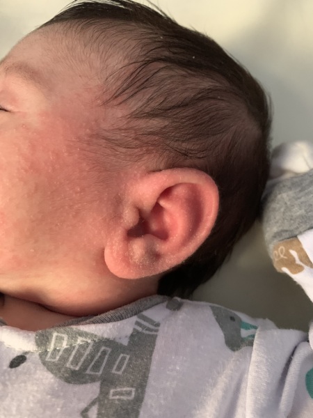 Eczema or rash?