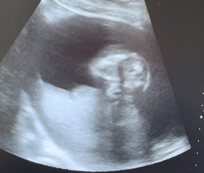 Any ultrasound techs here ? Is this a potty shot?