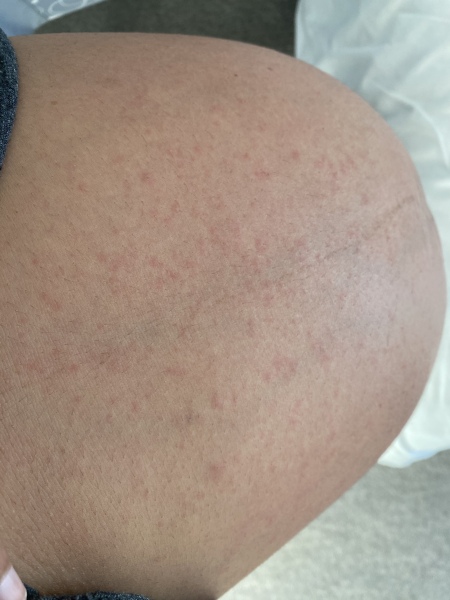 Itching like crazy! 