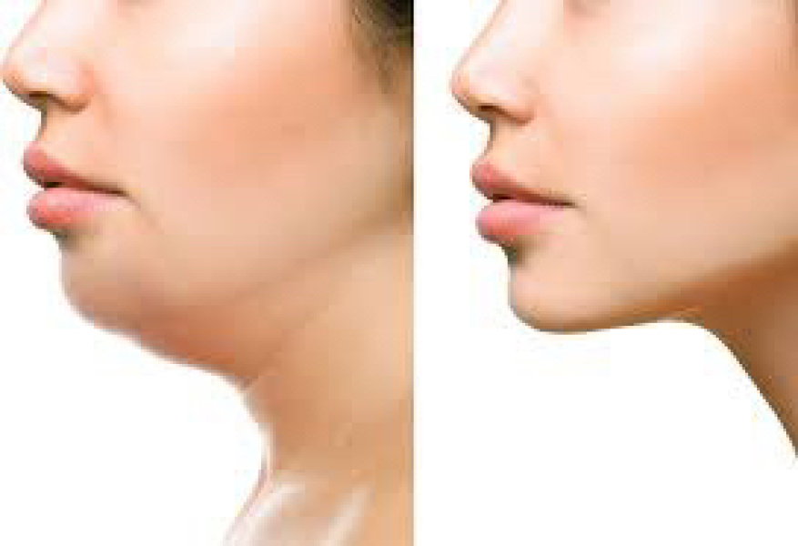 Weak chin - what treatment?