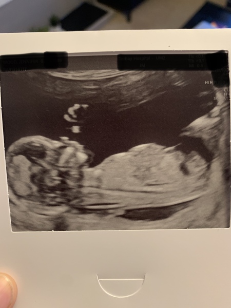 Comparing scans - convinced I am having a girl - HELP