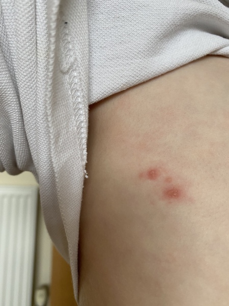 Bites or something else 