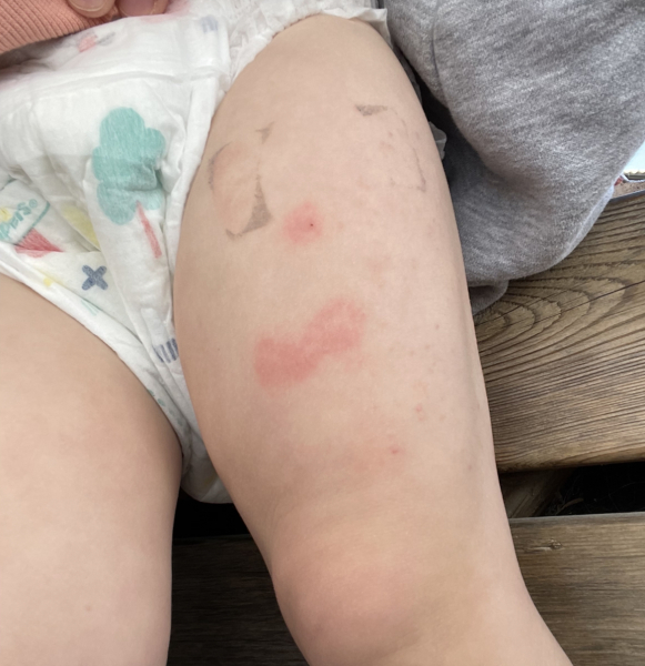 Polio Booster Reaction