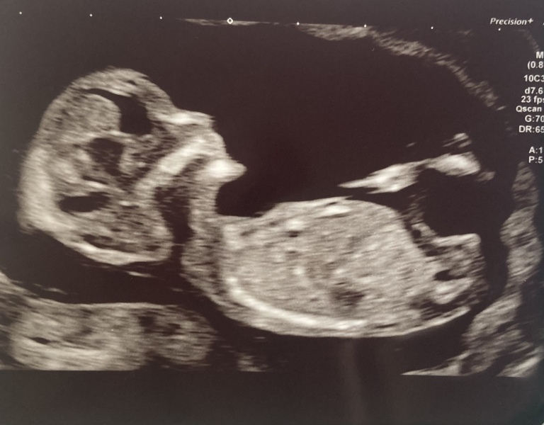 TTC after miscarriage thread 12 🌈✨💛💕