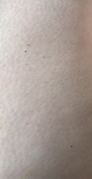 Petechiae or cherry angioma? Talk me down