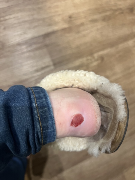 Photo included, do I need to see someone about these blisters?