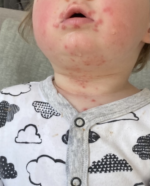 Oral thrush?