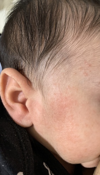Baby skin problem