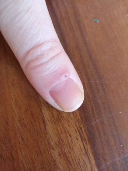 Is my thumb infected