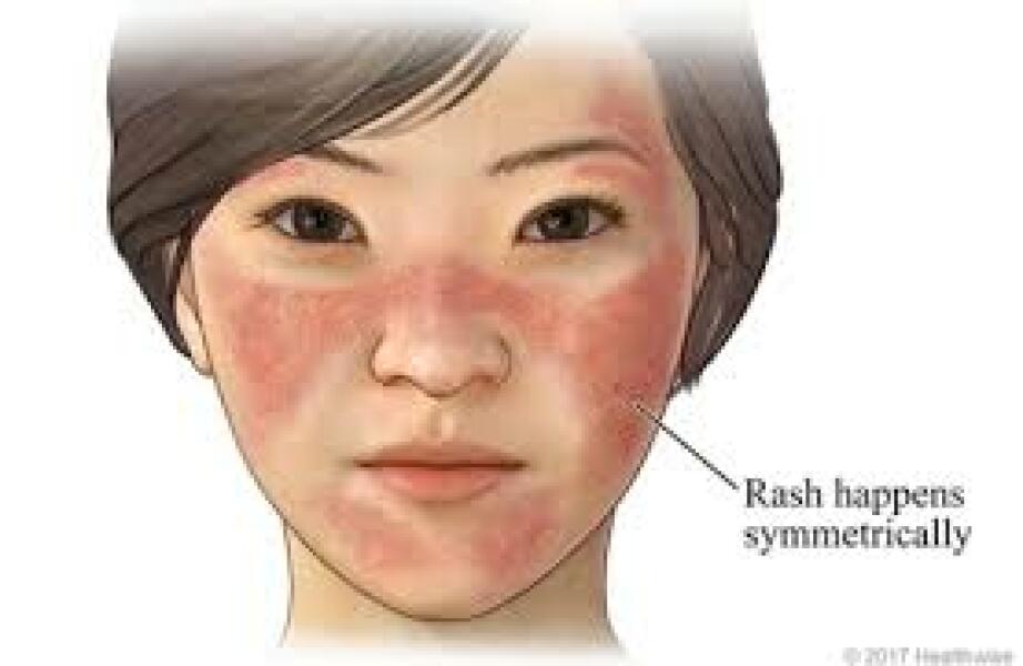 Please help identify this rash