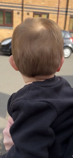 Nearly 1 year has one protruding ear