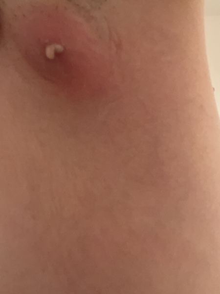 Help me - infected cyst