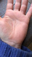 PICTURE: Wtf are these painful bumps on my hands and fingers? 
