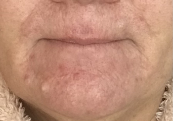 Hormonal acne - what actually works?