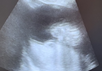 Any ultrasound techs here ? Is this a potty shot?