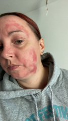 Please help identify this rash