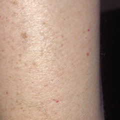 Petechiae or cherry angioma? Talk me down