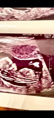 Girl or Boy Nub in Scan
