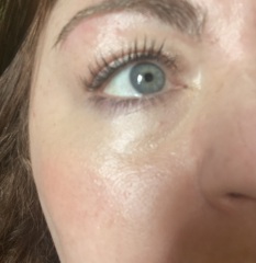 Under eye hollows/dark circles advice