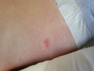 Larger red spots on 6 month old babies back
