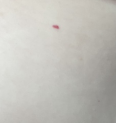 Petechiae or cherry angioma? Talk me down