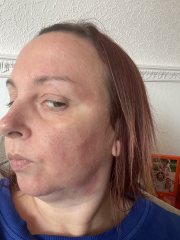Please help identify this rash