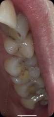 Gross pic I'm sorry, but wtf has happened to my teeth?