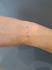 Are these tattoos from during surgery? If so, why?