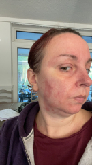 Please help identify this rash