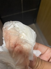 Implantation bleeding