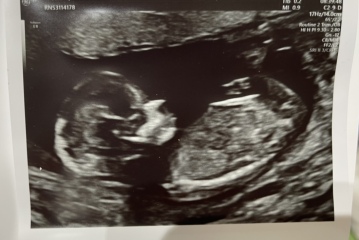 Is it baby’s nub?