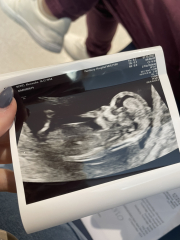Very early pregnancy and so much anxiety after miscarriage