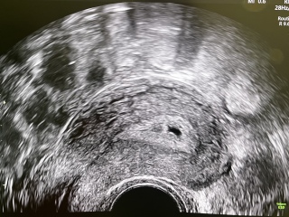 Did they see anything on your early scan?