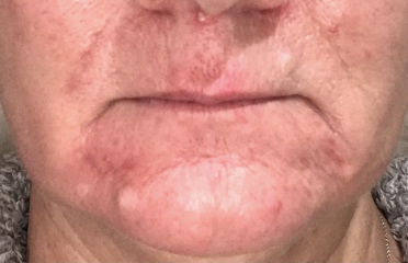 Hormonal acne - what actually works?