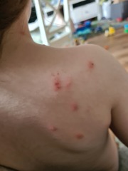 Is this chicken pox? 