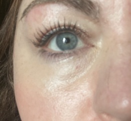 Under eye hollows/dark circles advice