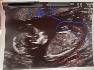 Is it baby’s nub?
