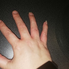 To ask about hives and swollen fingers. 
