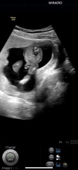 Boy or Girl ? 16 weeks potty shots