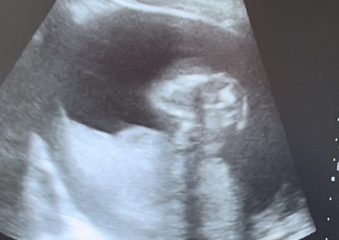 Any ultrasound techs here ? Is this a potty shot?