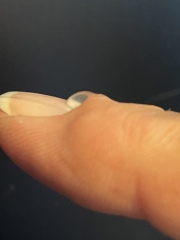 Anyone had a myxoid cyst?