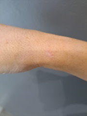 Are these tattoos from during surgery? If so, why?