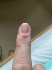 Anyone had a myxoid cyst?