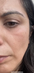 Does this look like Rosacea?