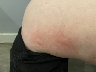 False widow bite - 7 days on