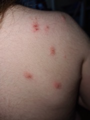 Is this chicken pox? 