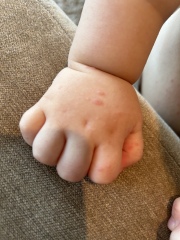 Abroad and need help identifying rash